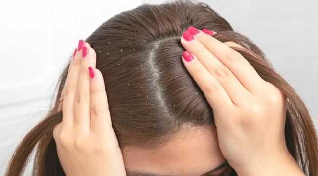 وصفات طبيعية للتخلص من قشرة فروة الرأس.. خطوات بسيطة